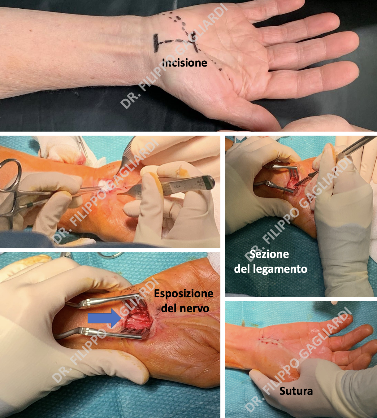 Neuropatie compressive periferiche