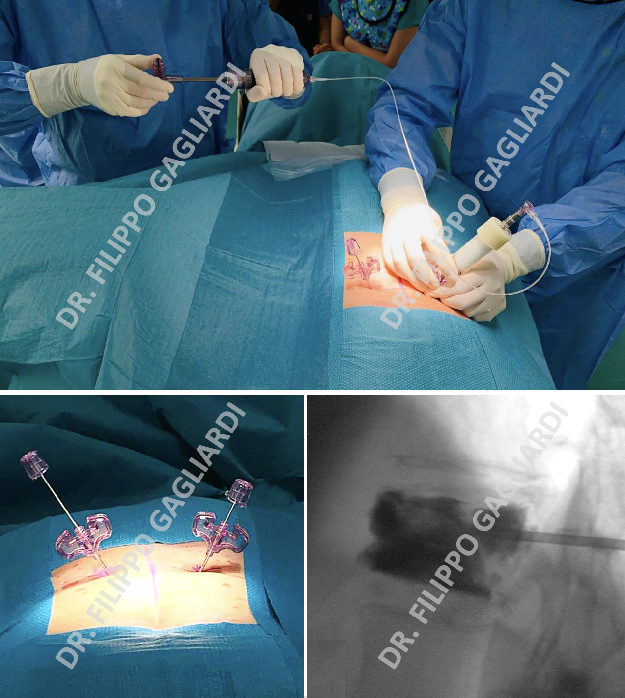 Vertebroplastica e cifoplastica