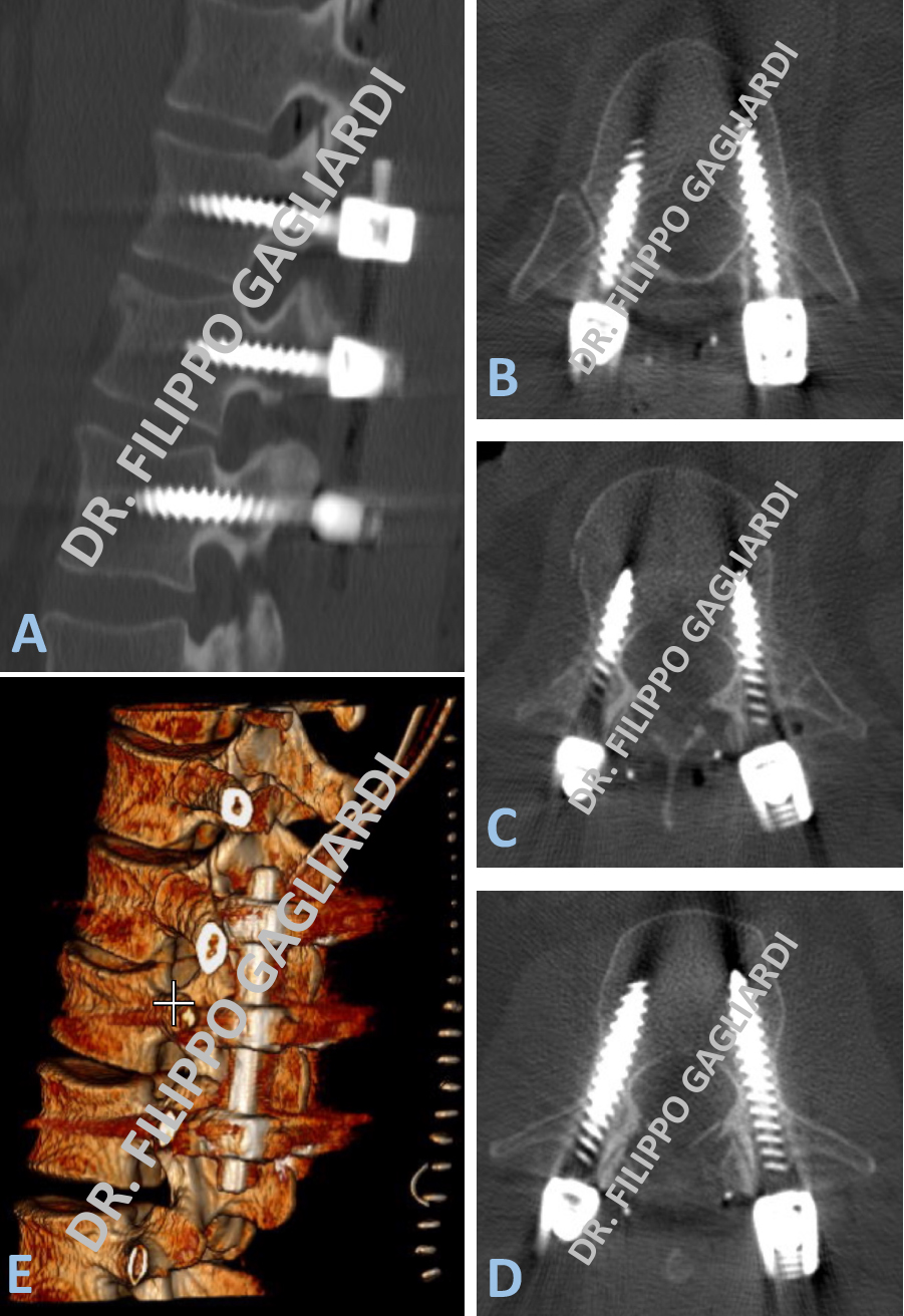 stabilizzazione lombare Patologie traumatiche del rachide lombare