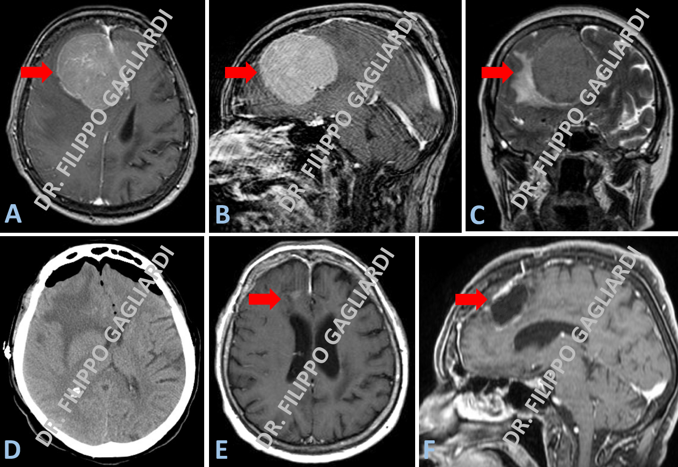 meningioma