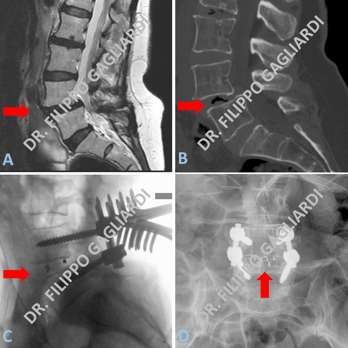 patologia lombare degenerativa