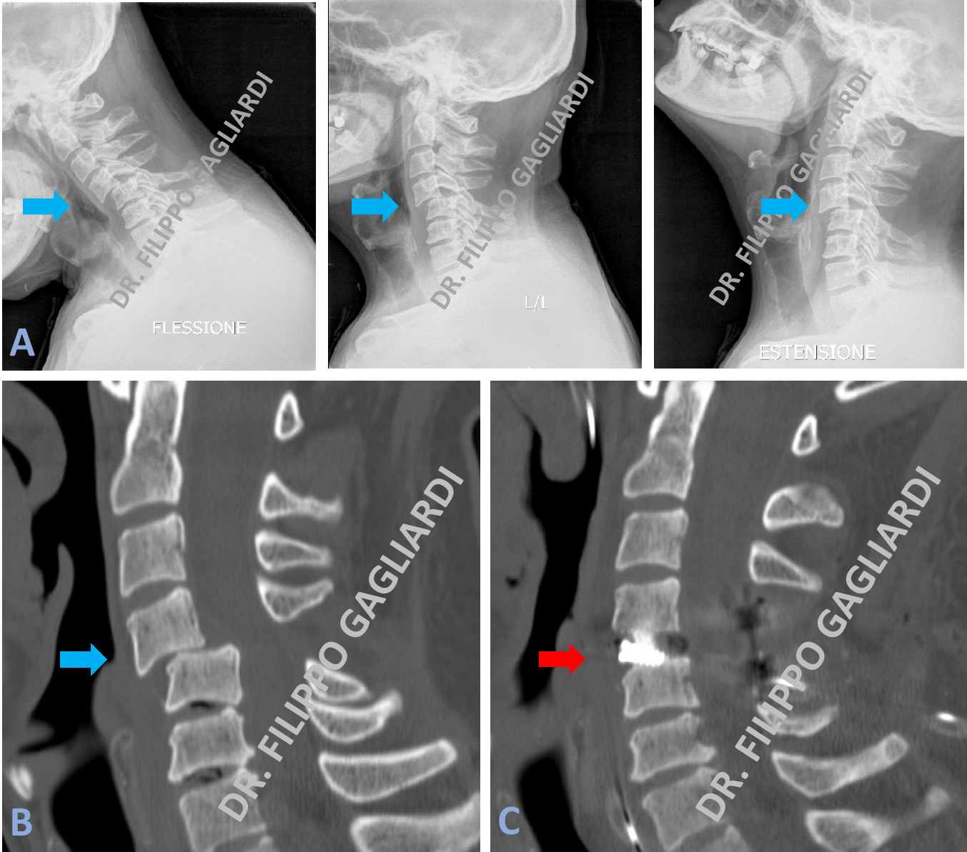lussazione vertebrale cervicale