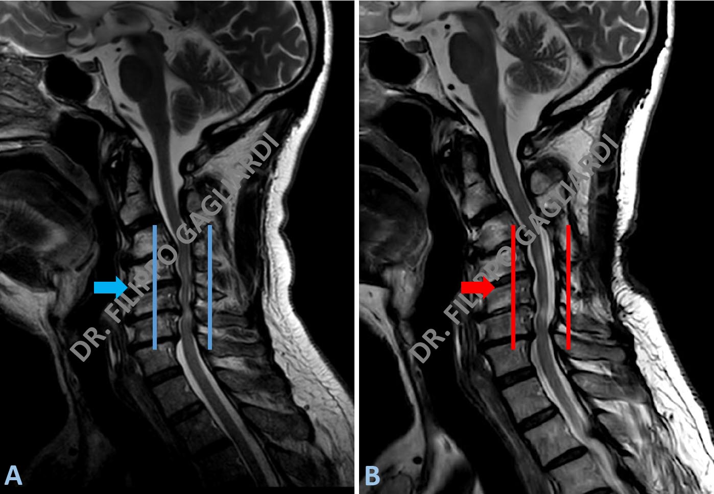 stenosi del canale cervicale
