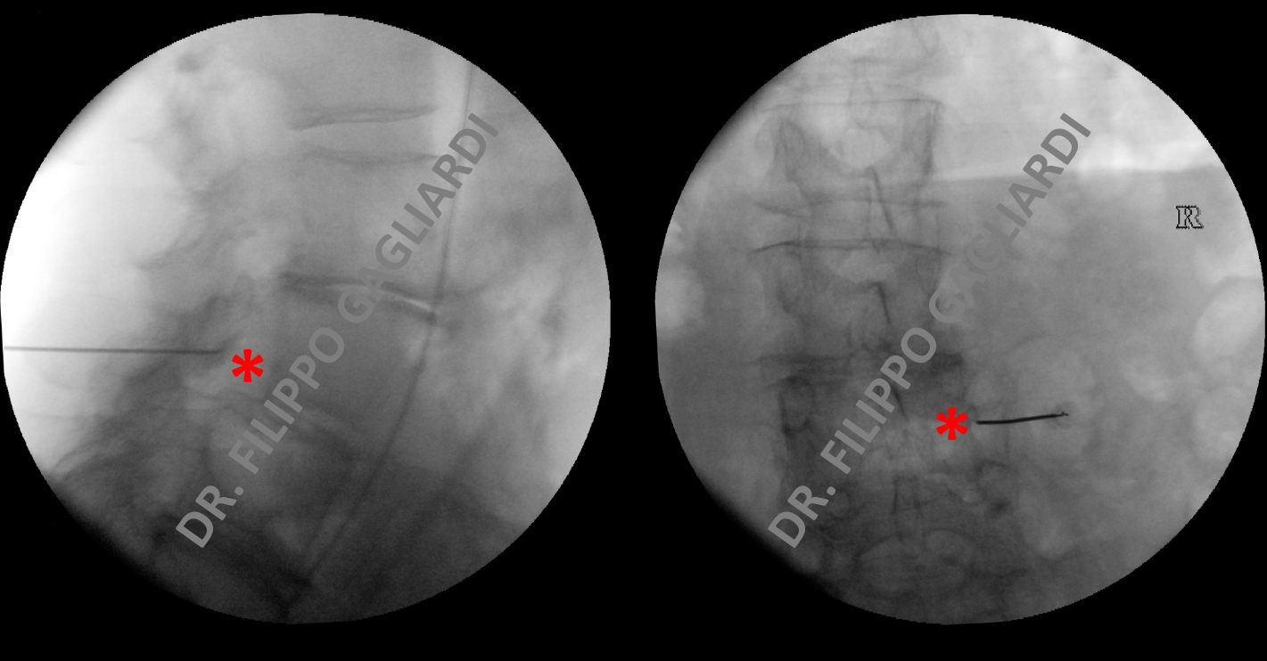 Infiltrazioni e terapia del dolore